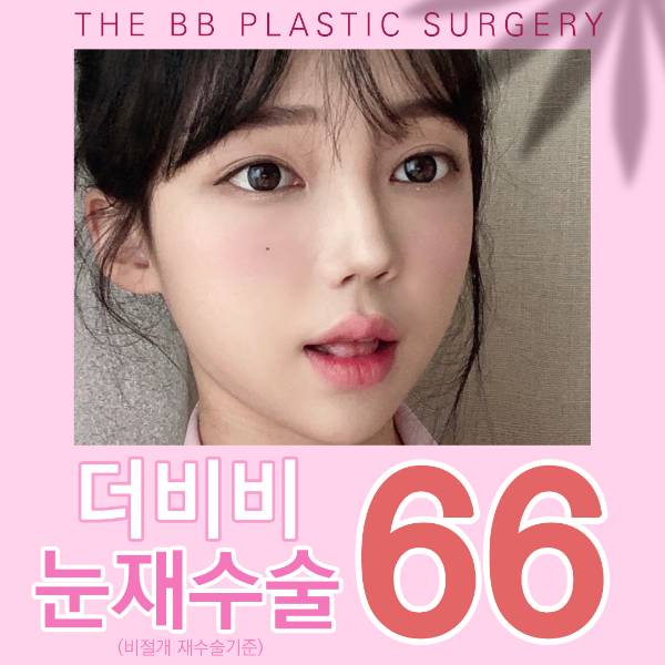 더비비 눈재수술